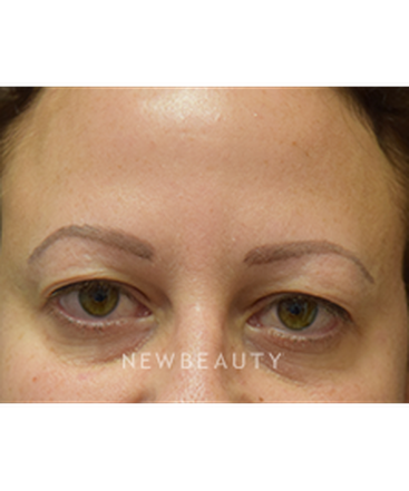 dr-jeffrey-b-wise-upper-blepharoplasty-b