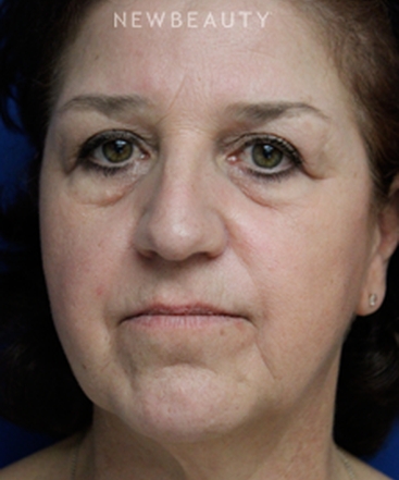 dr-joseph-russo-restoring-a-natural-look-eye-ebg-b