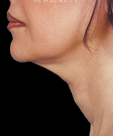 dr-ava-shamban-injectables-fillers-b