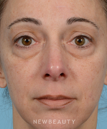 dr-jeffrey-b-wise-lower-blepharoplasty-b