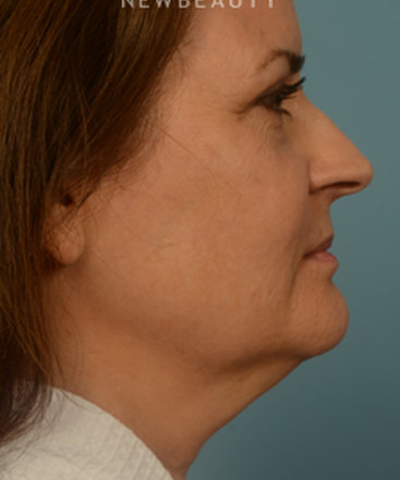 dr-bryan-gawley-facelift-b