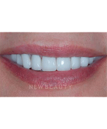 dr-guy-lewis-veneers-b