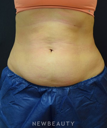 dr-jeffrey-b-wise-coolsculpting-b