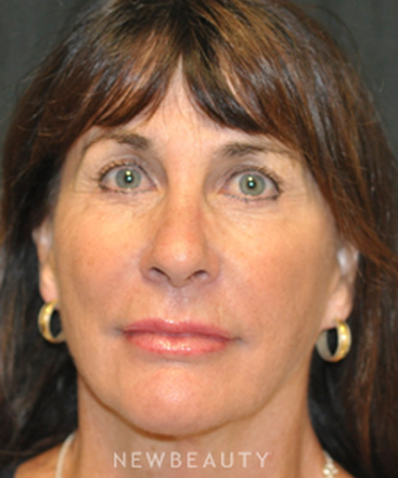 dr-andrew-smith-facelift-b