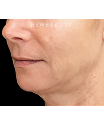dr-janet-allenby-liquid-facelift-b