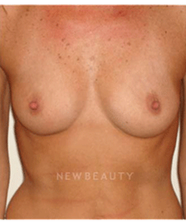 dr-michael-horn-silicone-breast-implants-b