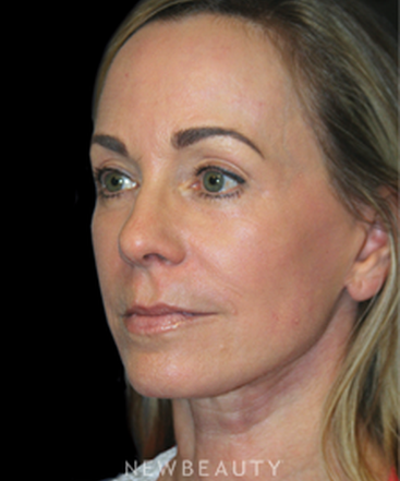dr-brent-smith-mini-facelift-lasers-b