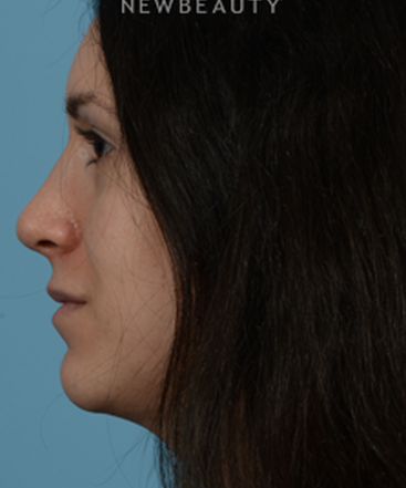 dr-jeffrey-wise-rhinoplasty-b