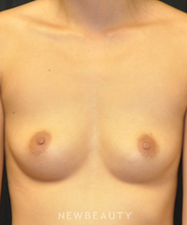 dr-andrew-smith-breast-augmentation-b