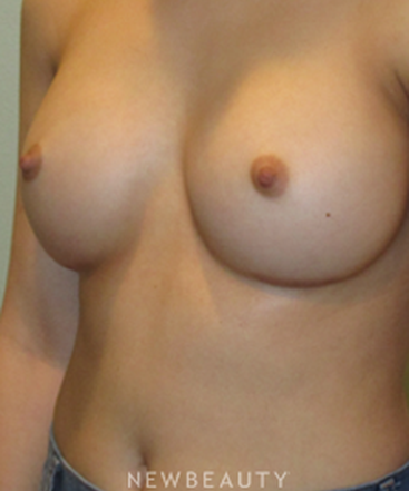 dr-michael-horn-breast-augmentation-b