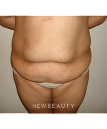 dr-michael-horn-tummy-tuck-b