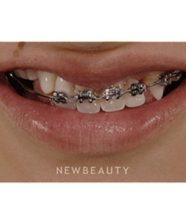 dr-ronald-goldstein-smile-makeover-b