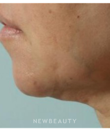 dr-marina-peredo-necklift-b
