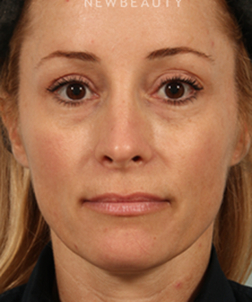 dr-kenneth-r-beer-juvederm-b