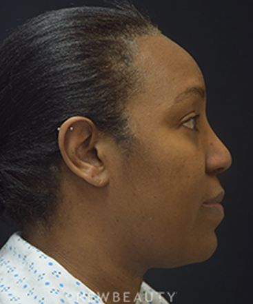 dr-jeffrey-b-wise-lipo-rhinoplasty-b
