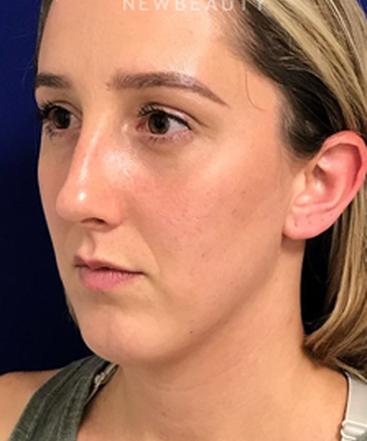 dr-dilip-madnani-lower-blepharoplasty-b