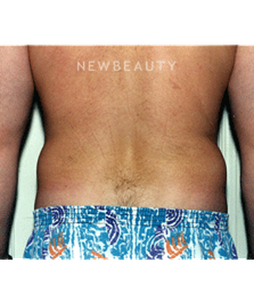 dr-david-rapaport-liposuction-b
