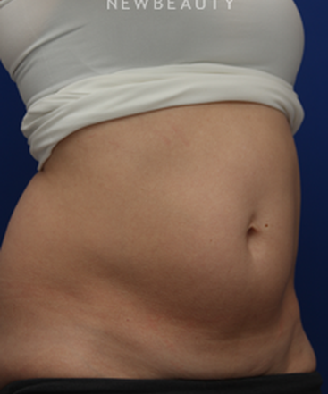dr-jennifer-levine-sculpsure-b