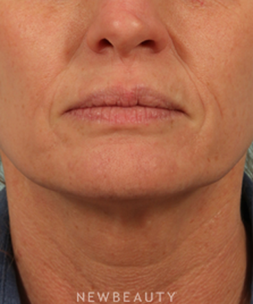 dr-kenneth-beer-injectables-fillers-juvederm-b