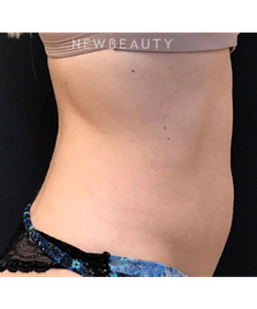 dr-janet-allenby-emsculpt-b