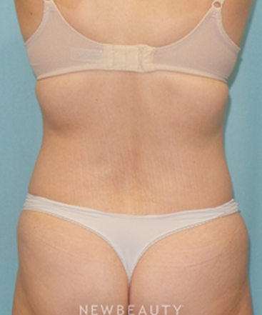 dr-sean-simon-smartlipo-b