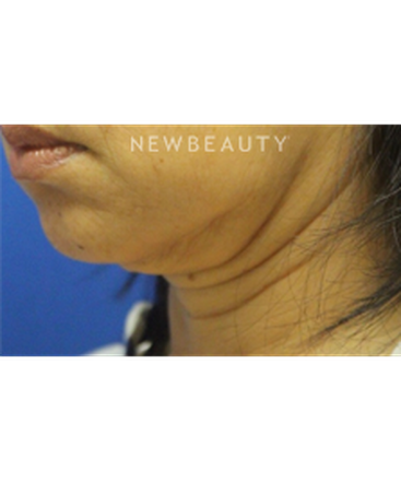 dr-jennifer-levine-botox-b