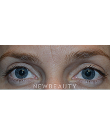dr-baljeet-purewal-upper-blepharoplasty-b
