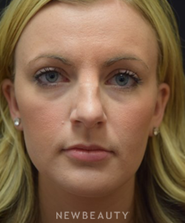 dr-jeffrey-b-wise-rhinoplasty-b