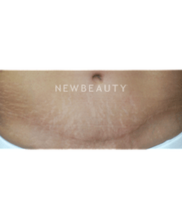 dr-kenneth-beer-fraxel-stretchmarks-b