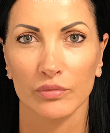 dr-dilip-madnani-minilift-injectables-b