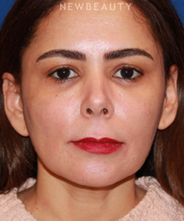 dr-dilip-d-madnani-mini-facelift-b