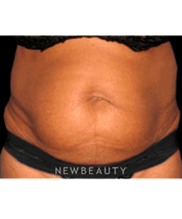 dr-sanjay-grover-tummy-tuck-b