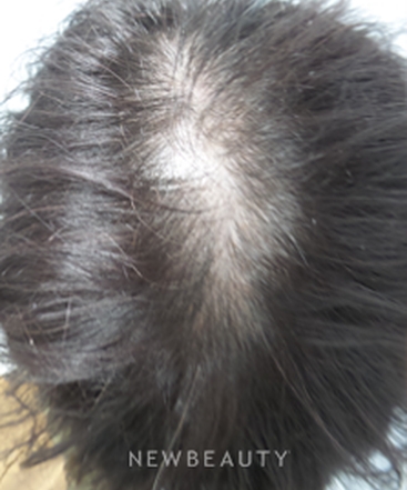 dr-marina-peredo-hair-loss-treatment-b