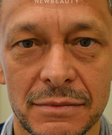 dr-bajeet-purewal-upper-and-lower-blepharoplasty-b