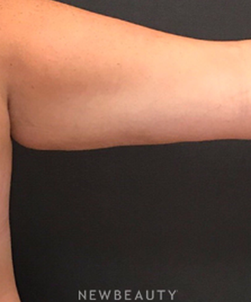 dr-janet-allenby-coolsculpting-b