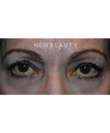 dr-baljeet-k-purewal-upper-blepharoplasty-b