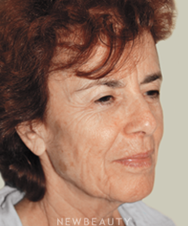 dr-david-rapaport-facelift-necklift-b