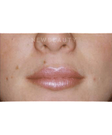 dr-charles-crutchfield-aesthetic-injectables-b