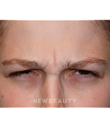 dr-marina-peredo-botox-b