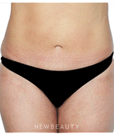 dr-david-rapaport-liposuction-b