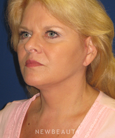 dr-dilip-d-madnani-facelift-necklift-b