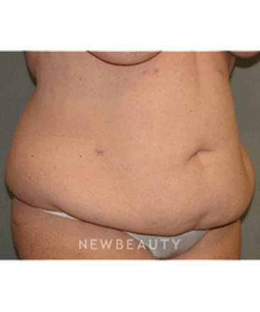 dr-sean-simon-tummy-tuck-lipo-b