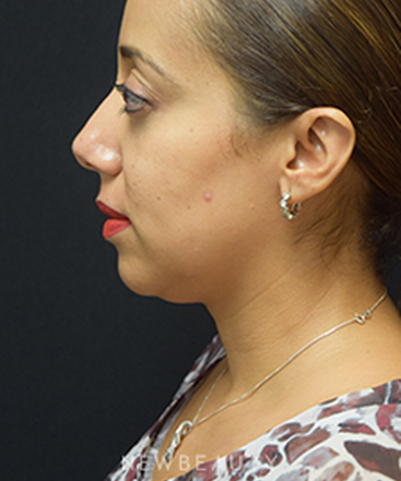 dr-jeffrey-b-wise-kybella-b