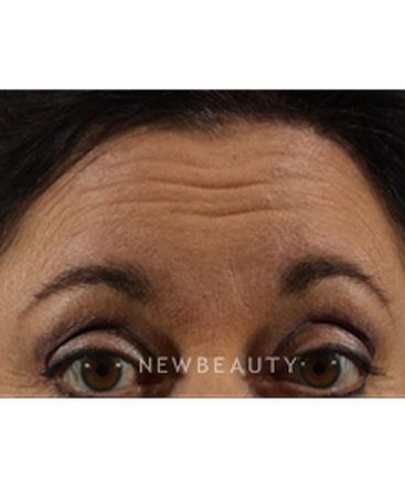 dr-marina-peredo-botox-b