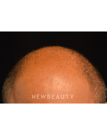 dr-jeffrey-b-wise-hair-transplant-b