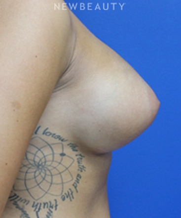 dr-joseph-russo-enhancing-curves-breast-ebg-b