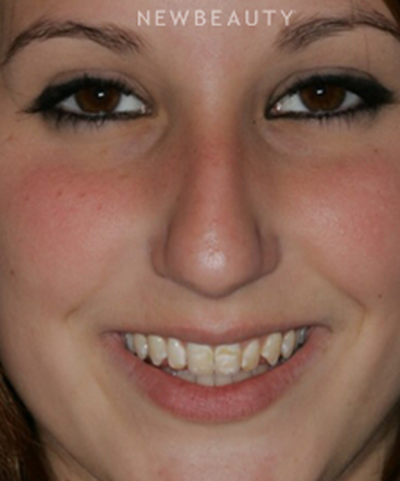 dr-laurence-rifkin-veneers-b