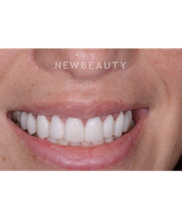 dr-guy-m-lewis-smile-makeover-b