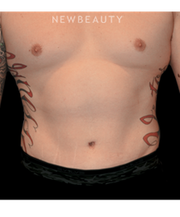 dr-bryan-w-gawley-a-tighter-midsection-b