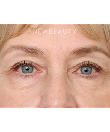 dr-raymond-douglas-blepharoplasty-b